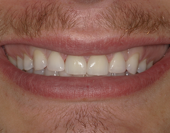 A close up image of a man's smile that has recently been whitened