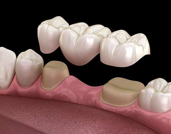 a rendering of a bridge being placed over damaged teeth