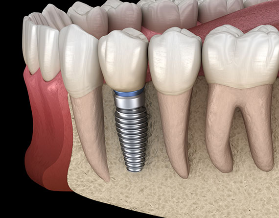 a medical rendering of an implant sitting in the gumline
