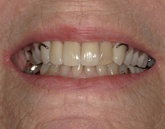 a close up of a women's mouth after having a precision attachment installed