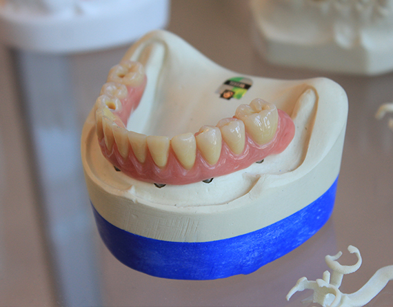  a set up full dentures being created by a dental technician
