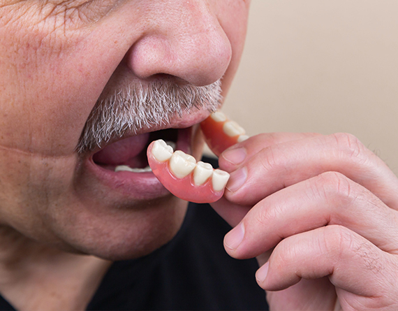 an older man putting a partial denture in his mouth