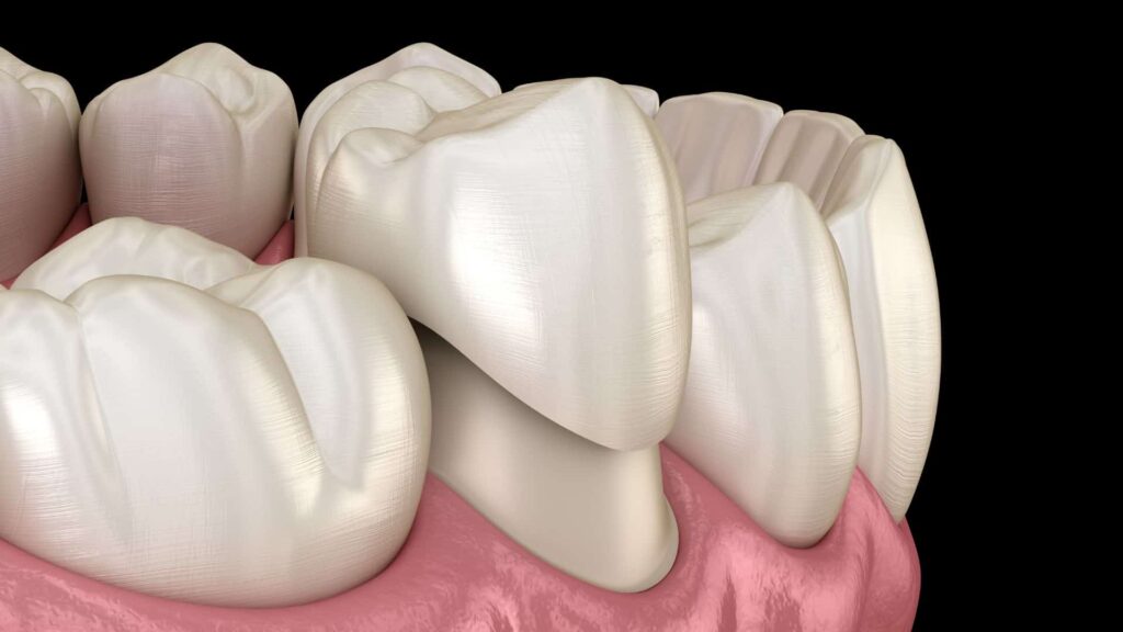 detailed dental illustration showing a tooth prepared for a dental crown, with the crown positioned above the reduced natural tooth to demonstrate full-coverage restoration.