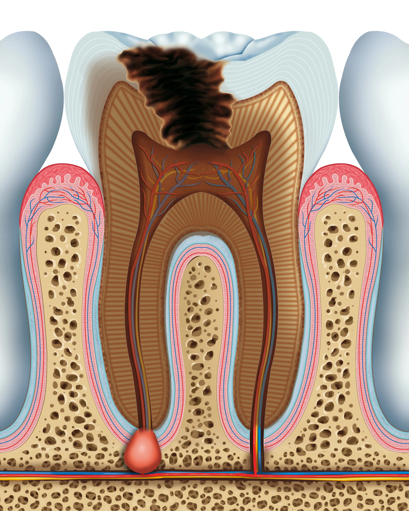 diagram of severe tooth decay showing what happens when we don't follow steps for how we can prevent tooth decay