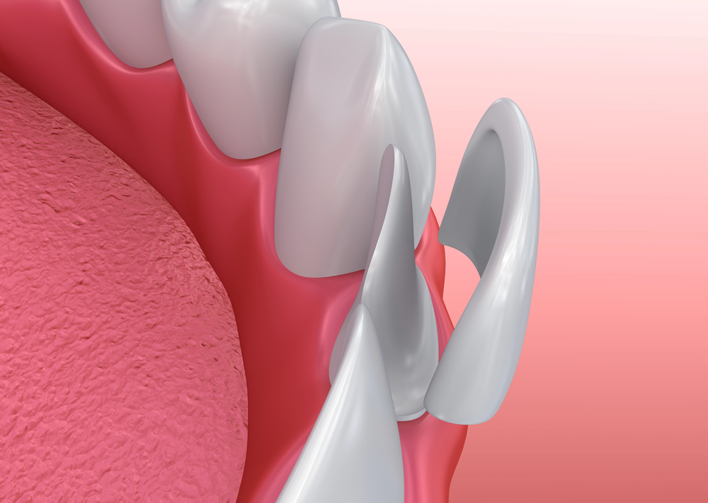 close-up dental illustration showing how a porcelain veneer is bonded to the front surface of a tooth.