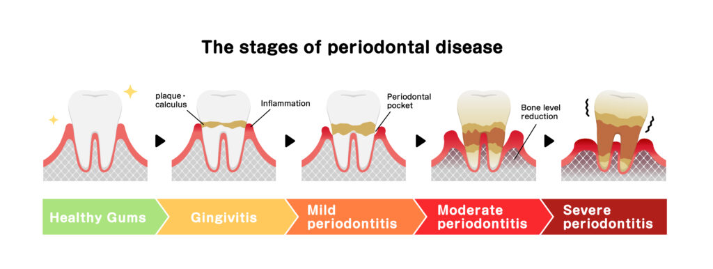 diagram illustrating the stages of periodontal disease from healthy gums to gingivitis, mild periodontitis, moderate periodontitis, and severe periodontitis with bone loss. 