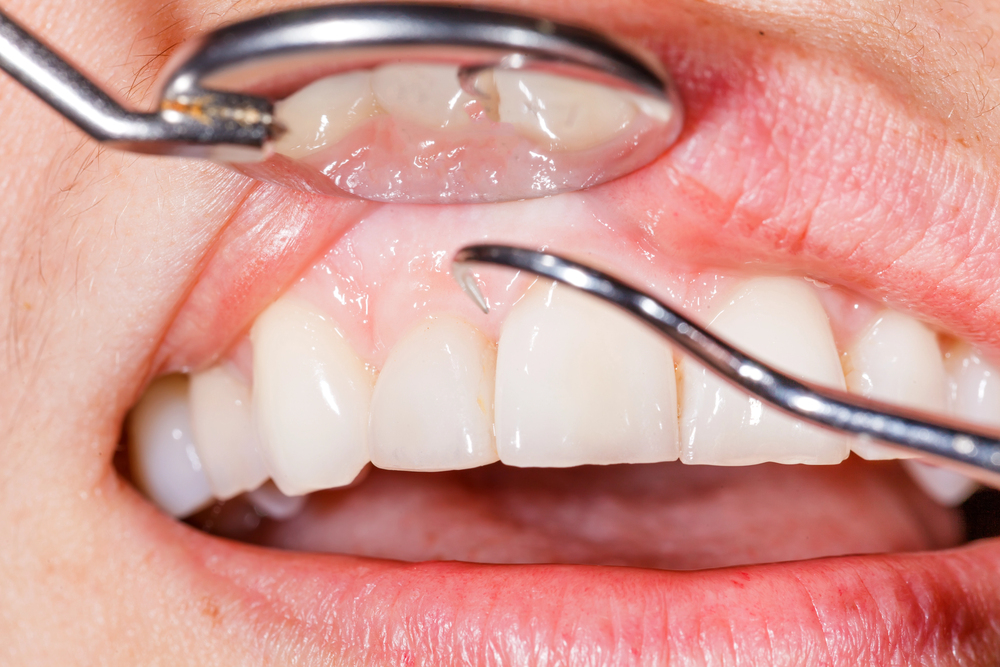 close up clinical photo showing enflamed gums and plaque buildup around the teeth during a dental examination with mirror and scaler