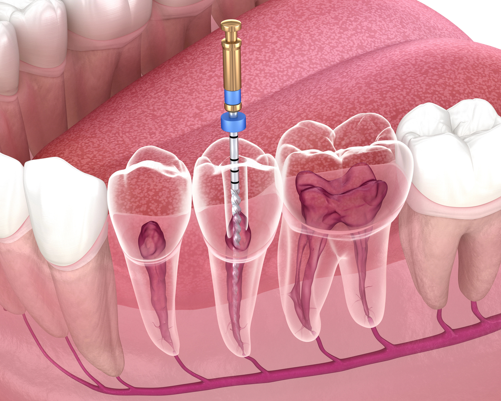 dental illustration showing a root canal procedure with instruments cleaning the inside of an infected tooth, often compared when explaining root canal vs extraction treatment options.