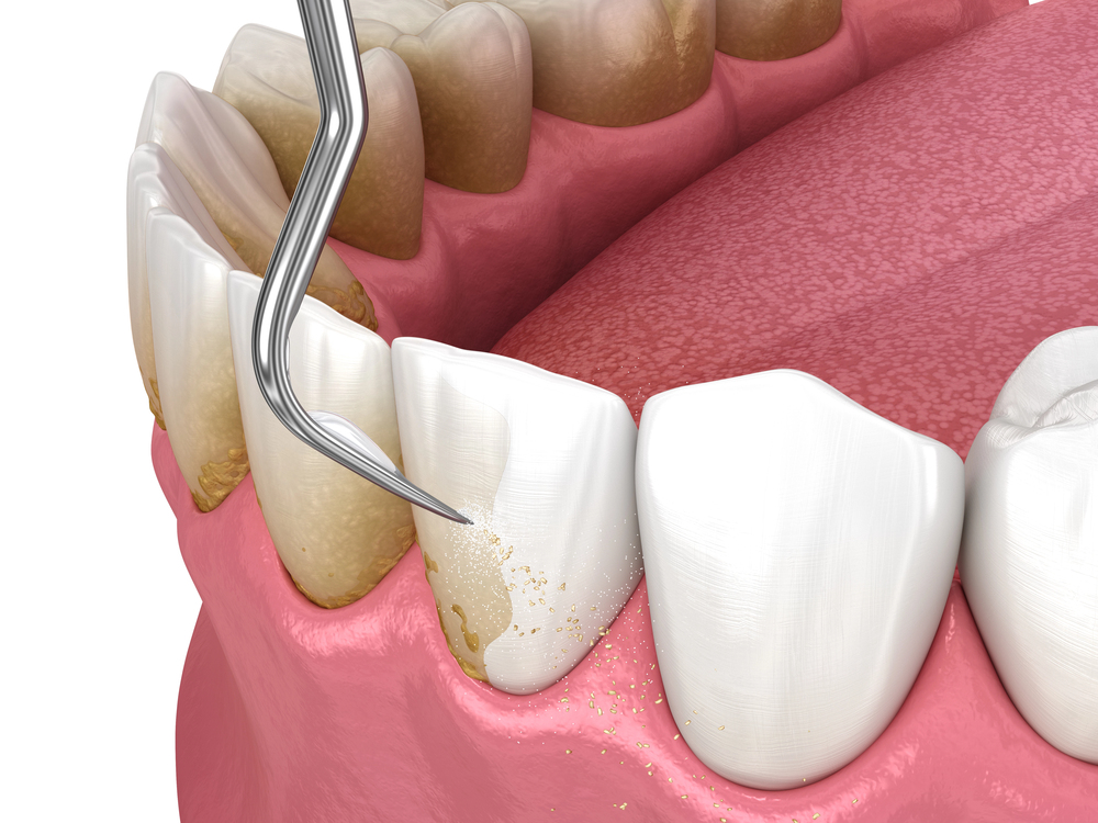 dental illustration showing plaque accumulation along the gum line and early gum inflammation as a visual comparison of gingivitis vs periodontitis.
