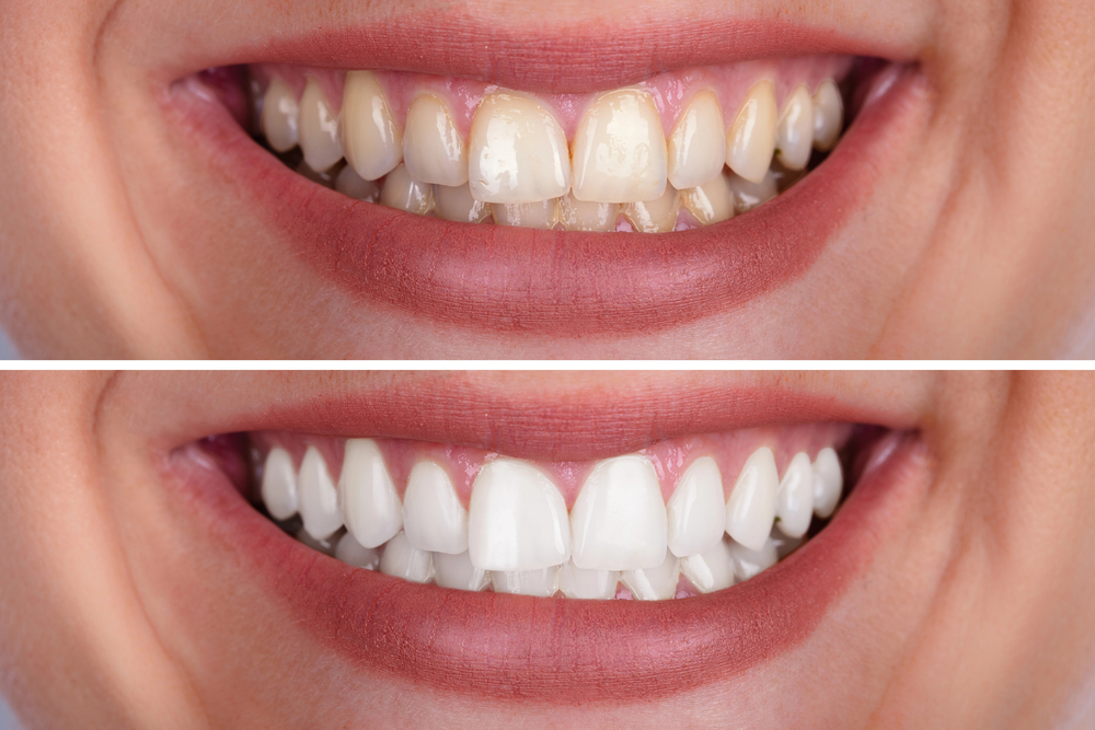 before and after comparison showing noticeable improvement after professional teeth whitening
