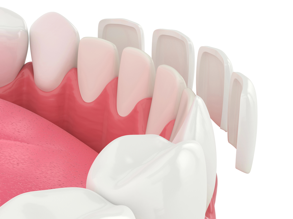 3D dental illustration showing veneers being placed on front teeth to demonstrate composite vs porcelain veneers treatment options.