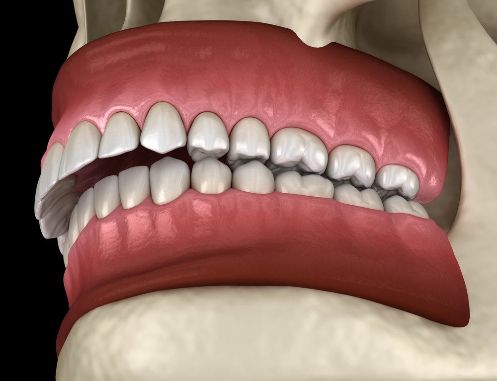 3D dental illustration showing overbite alignment, commonly used to explain overbite vs underbite and how teeth fit together.