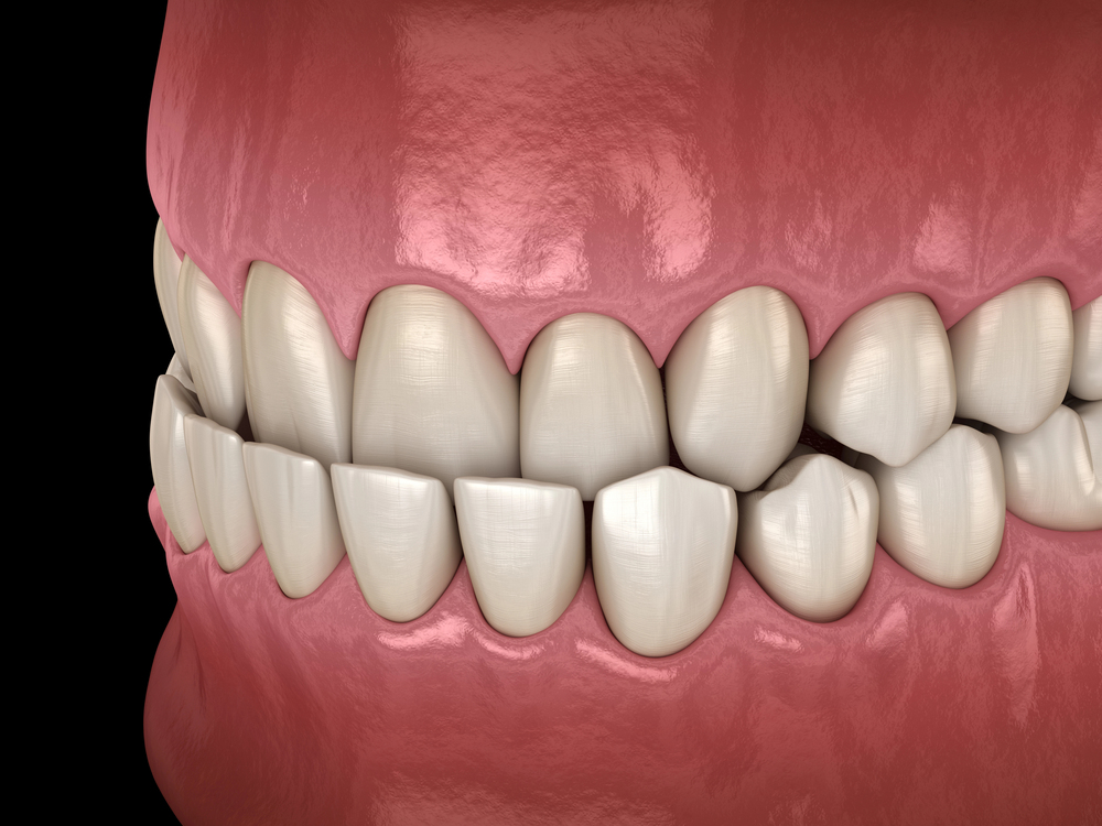 3D illustration showing an underbite