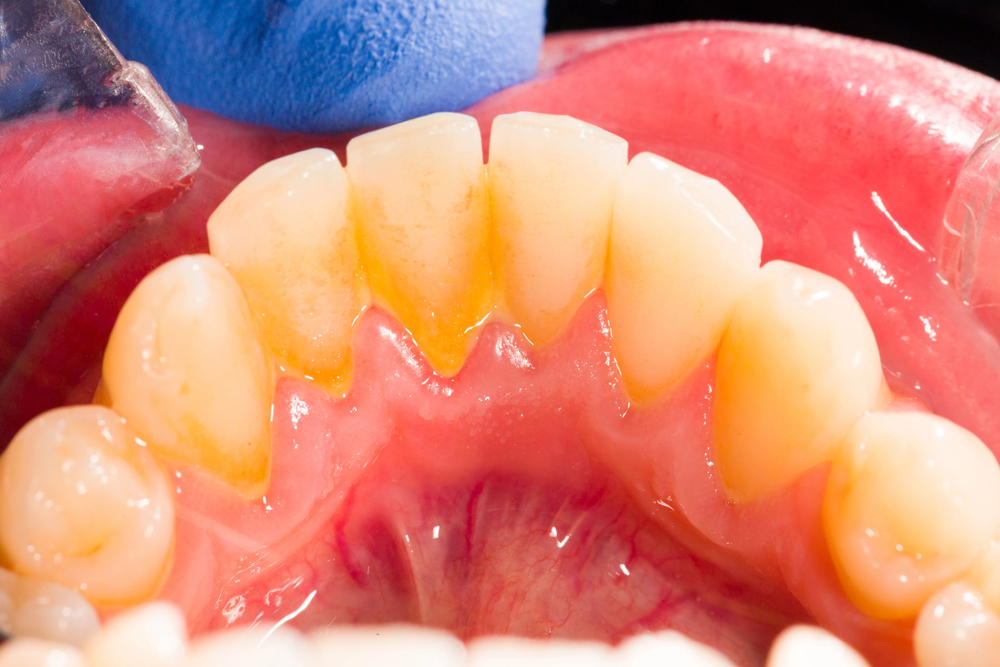 close-up of yellow staining and tartar buildup near gumline, showing common reasons why are my teeth yellow