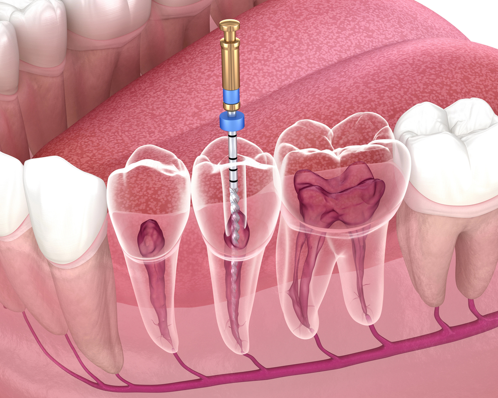 Detailed illustration of a root canal procedure showing infected pulp being removed from inside the tooth, supporting root canal recovery and healing.