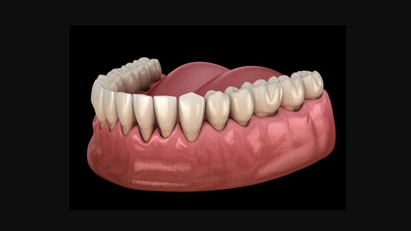 3D dental model showing teeth structure and gumline used to explain gum health and potential signs of gum disease.
