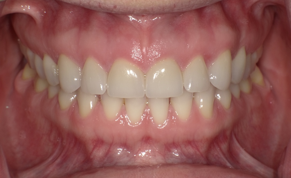 Close-up dental photo showing gumline and teeth used to illustrate healthy gums vs unhealthy gums and signs of gum health.