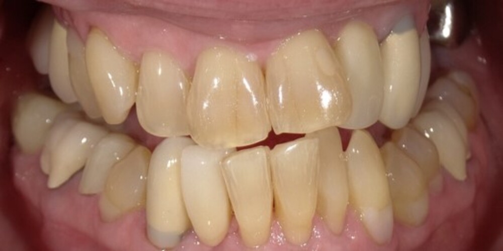 Close-up of crowded, discolored teeth with visible staining and plaque buildup, illustrating the difference between a cavity vs stain