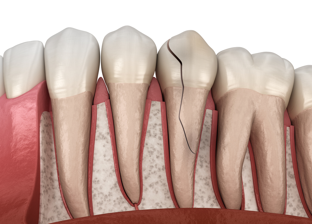 3D illustration of a cracked tooth extending below the gum line and into the root, showing surrounding bone and gum structure
