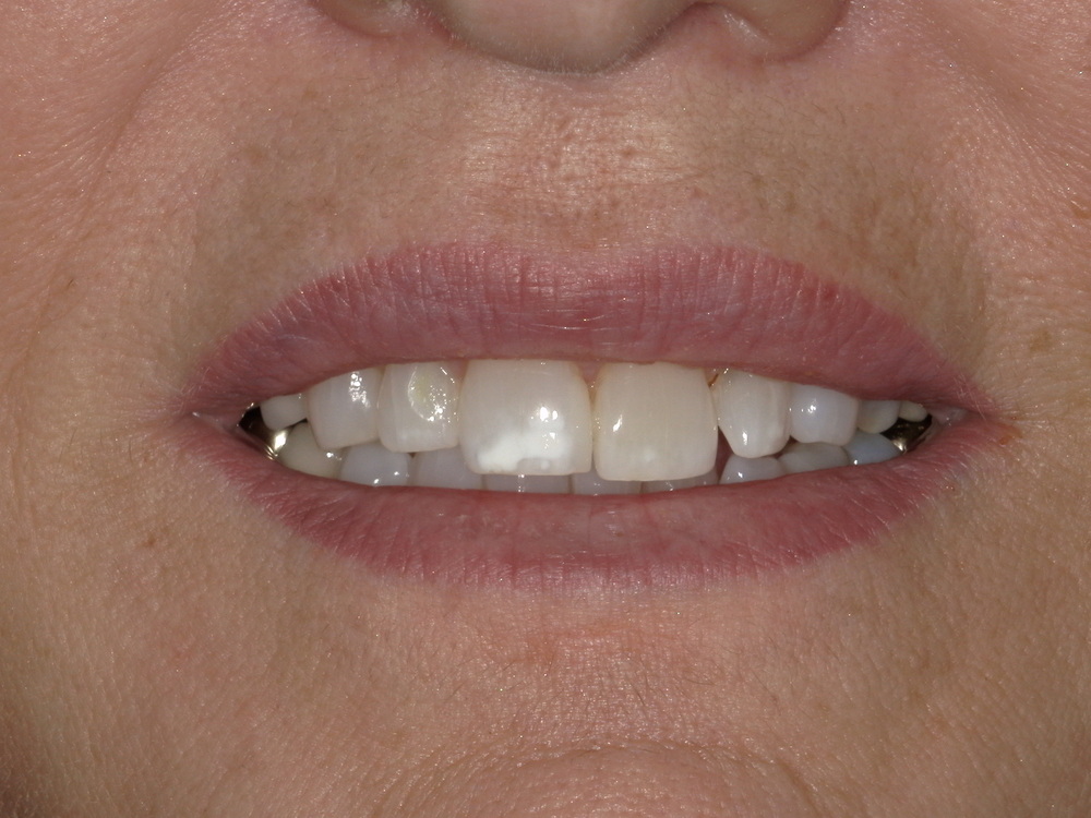 Close-up of patients teeth with a white stain on the front tooth.