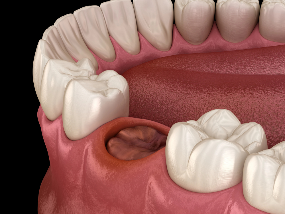 3D rendering of clotting socket after a tooth extraction emphasizing the importance of healing and what to eat after tooth extraction