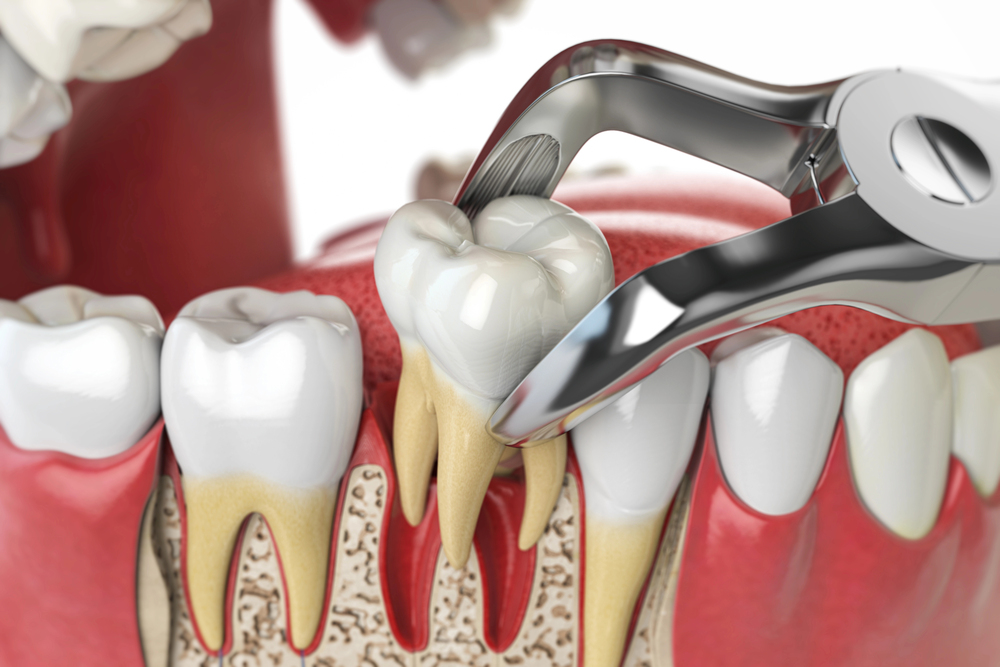 3D rendering off tooth being extracted