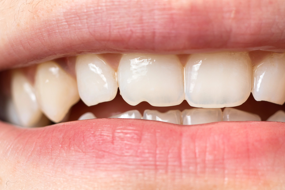 close up of chipped front tooth