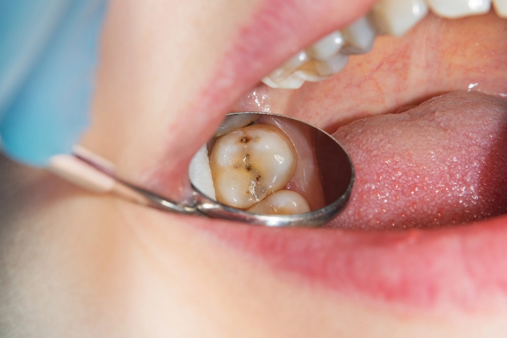 dentist using tool to view cavity in patient mouth
