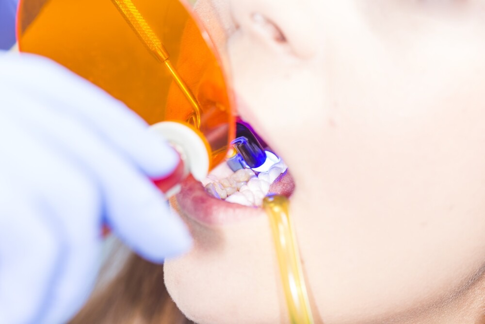 close up of dental bonding procedure as an option for how to fix a chipped tooth