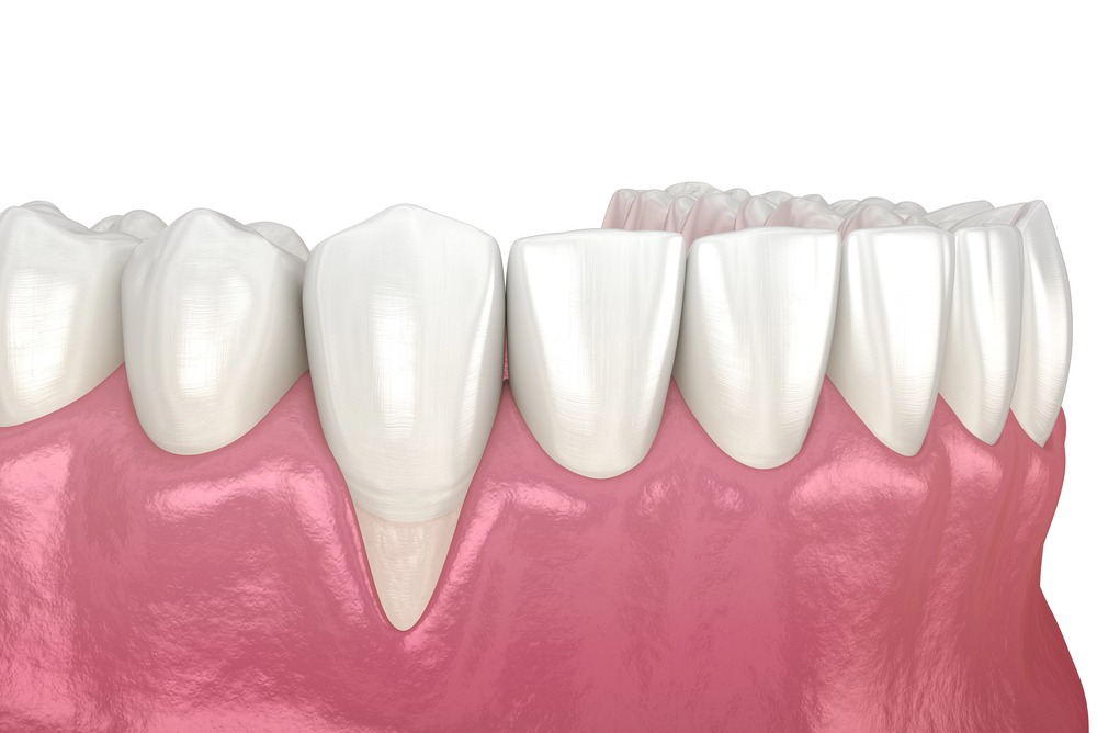 3D illustration of gum recession to illustrate possible reason of why are my teeth sensitive
