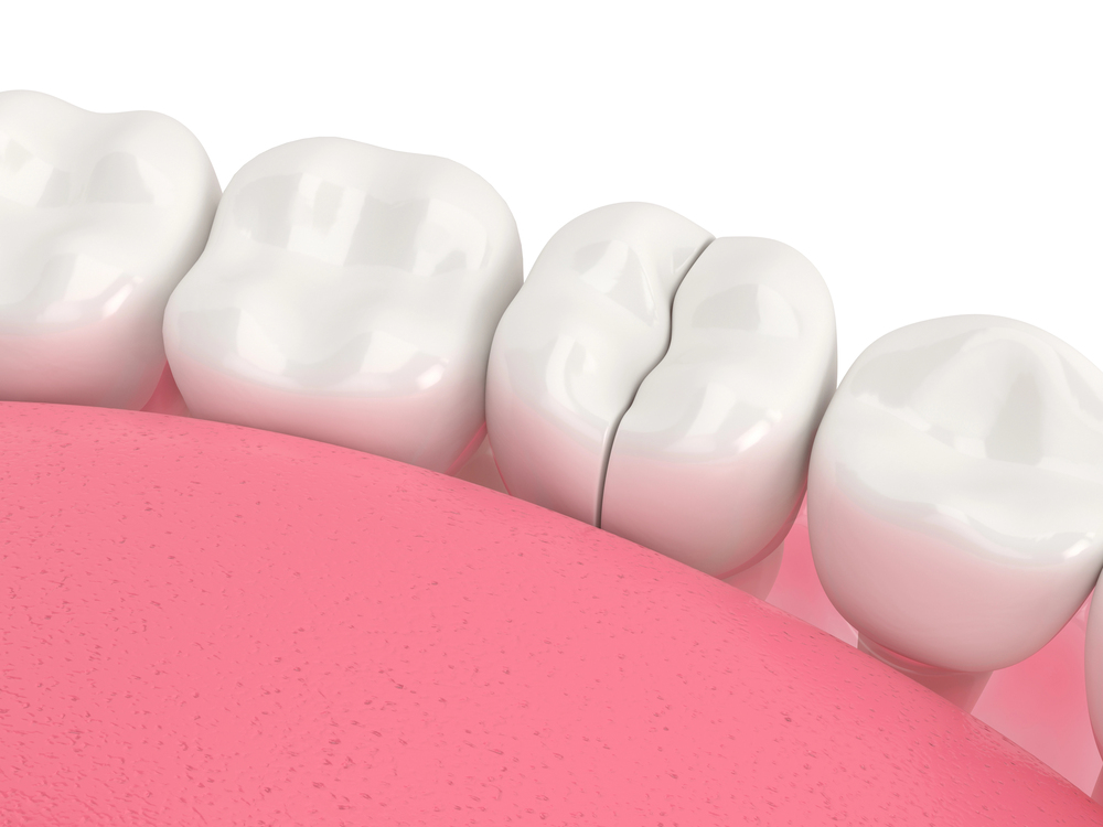 3D illustration showing broken dental crown