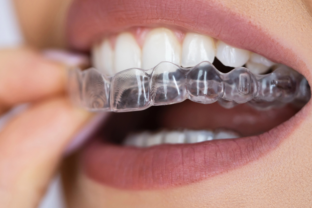 Person placing night guard over teeth
