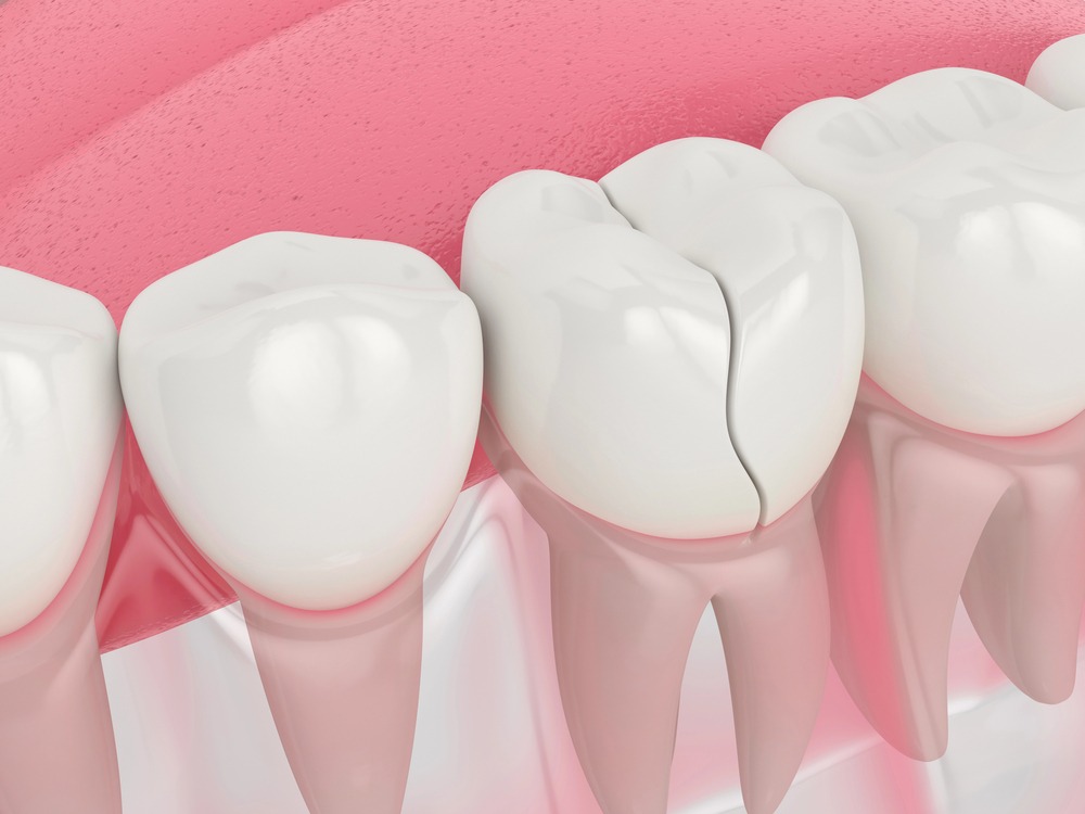 3D photo of cracked dental crown