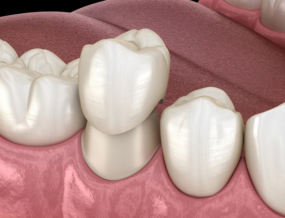 3D photo of replacement crown being placed on tooth