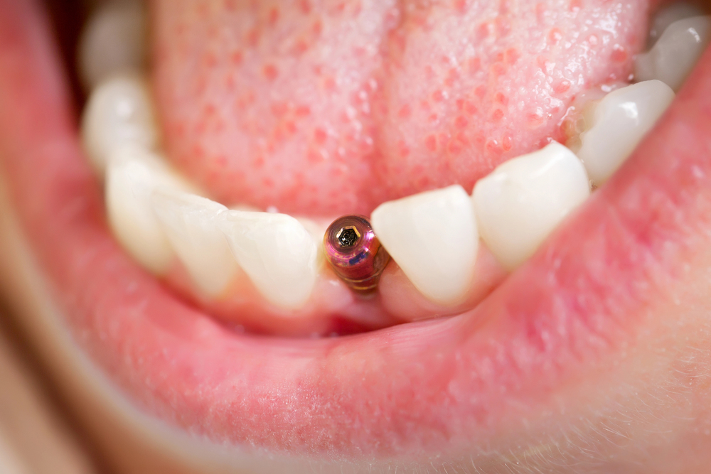 close up of dental implant post