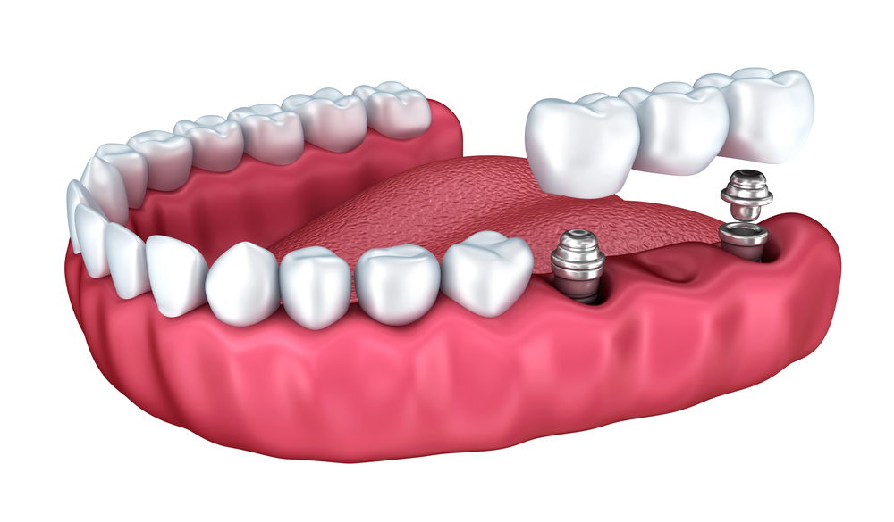 3D image of implant supported bridge