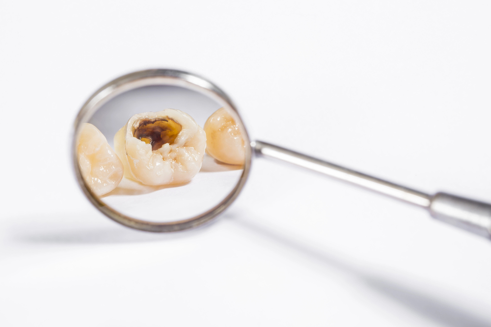 magnifying glass showing tooth with decay