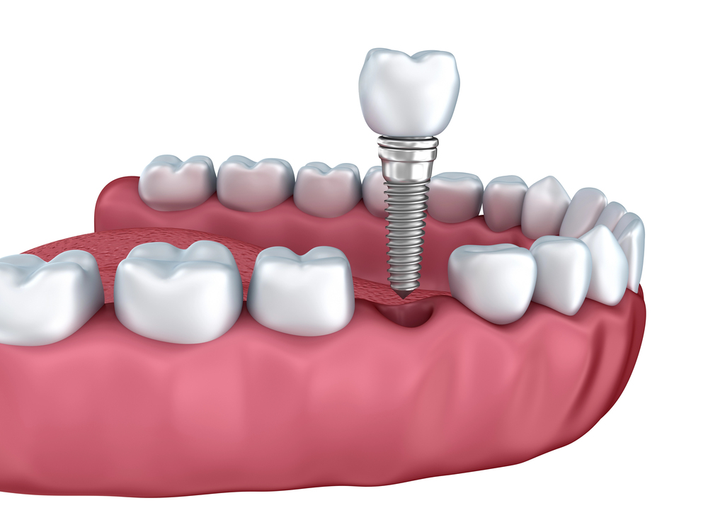 3D image of dental implant