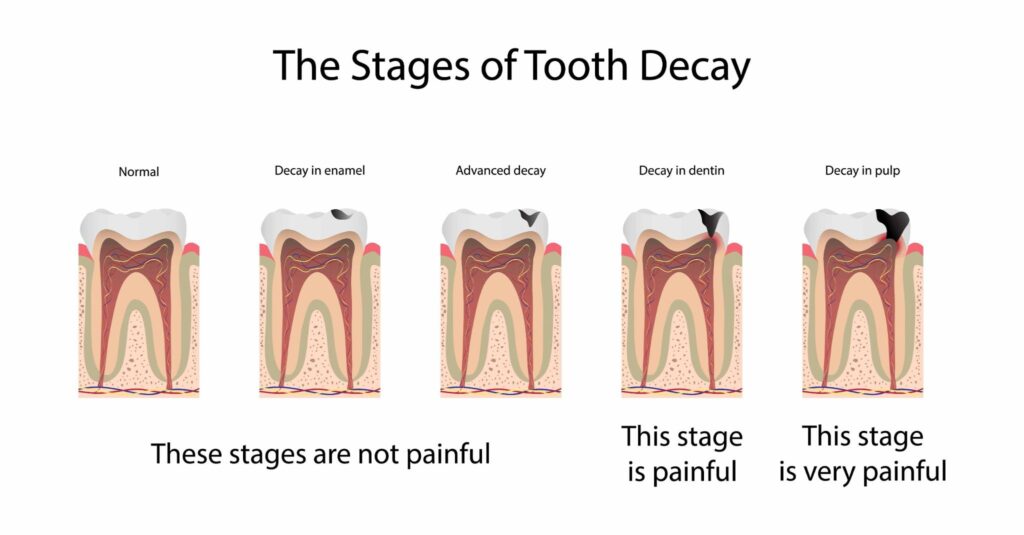 3D diagram showing 5 stages of tooth decay